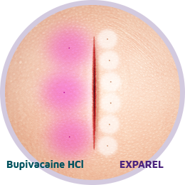 Surgical site comparison between EXPAREL administration and bupivacaine HCl administration