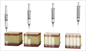 4 step cross-section revealing the technique for proper surgical site infiltration